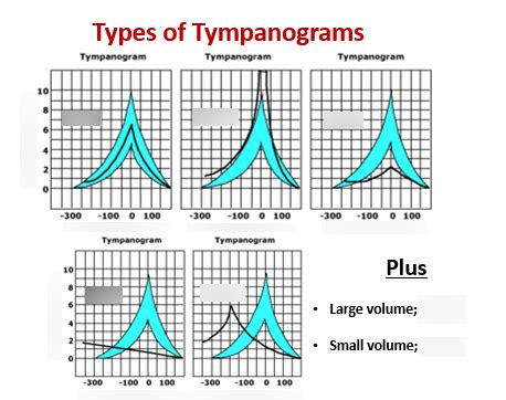 Common Types of Tympanograms .